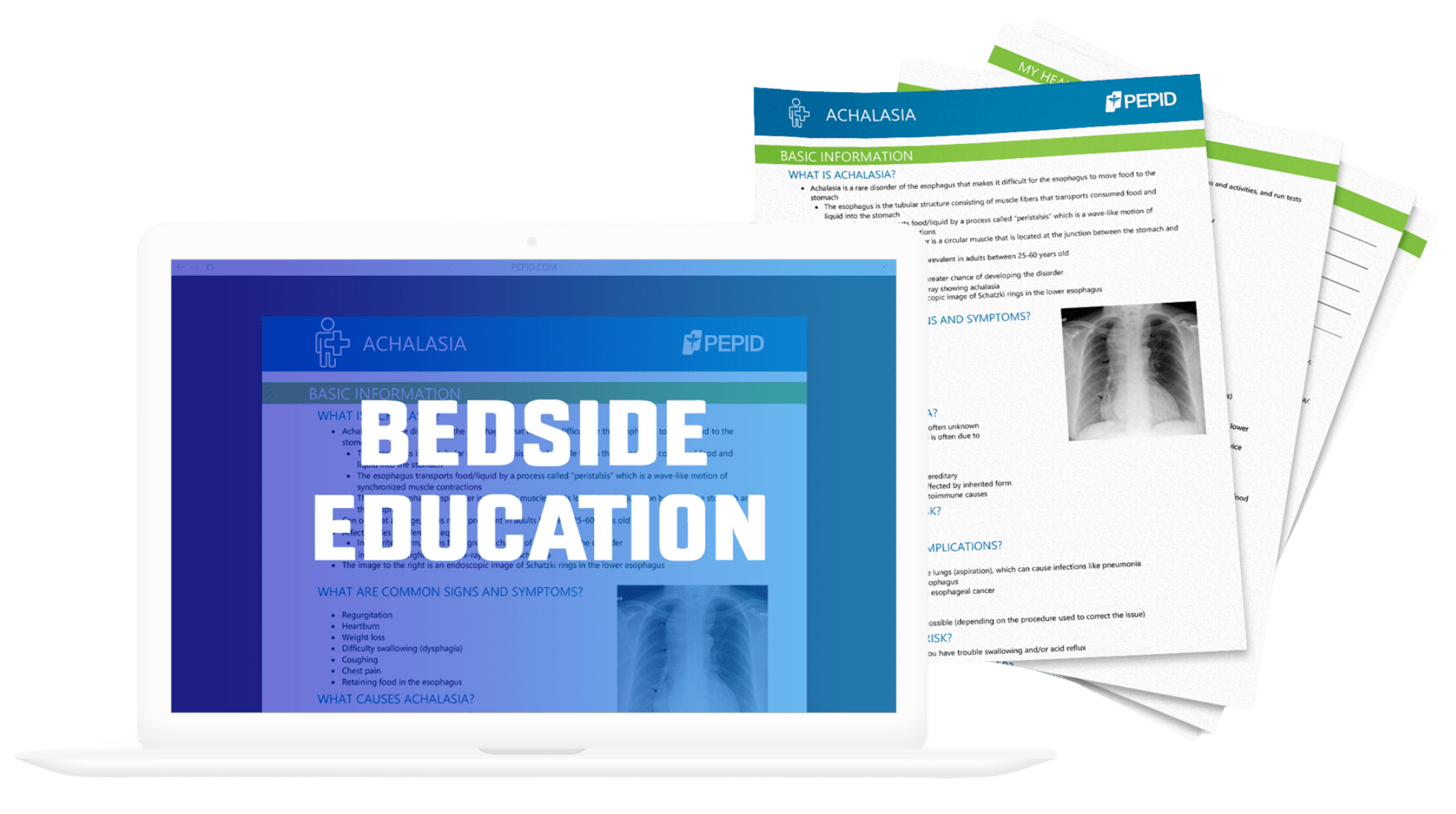 This image features an open laptop displaying the PEPID Bedside Education module on its screen, which is focused on the topic of achalasia. The screen shows detailed patient education content, including basic information and common signs and symptoms, with an endoscopic image of the esophagus. Beside the laptop, there are several printed patient handouts with similar content, highlighting the integration of digital and printed educational resources available through PEPID. The setup is designed to illustrate how healthcare professionals can use these tools to educate their patients about their conditions in a clinical setting.